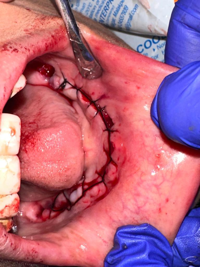 Patient consultation experience photo of Maxdent Tricity dental hospital and hair transplant centre zirakpur - Photo 3 at chandigarh 146006