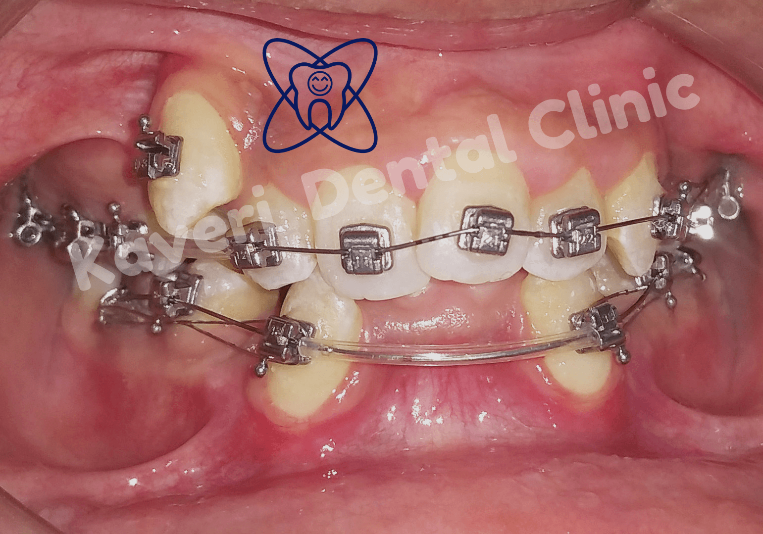 Clinic signage photo of Kaveri Dental Clinic and Orthodontic Hub - Photo 1 at Baripada 757001